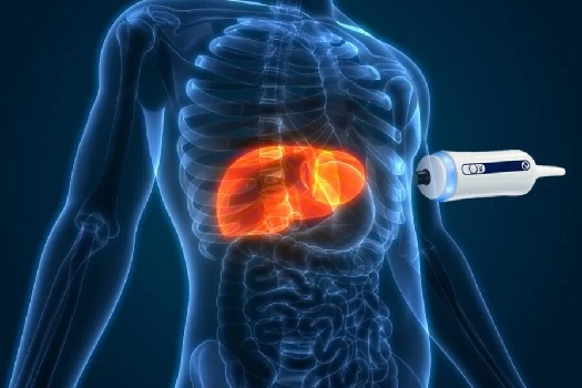 The Hidden Truth About Fibroscan 